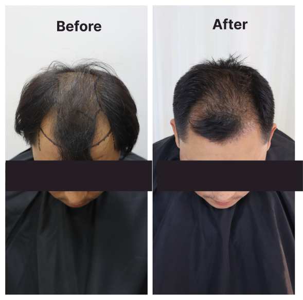 Hair Transplant result KOQ10